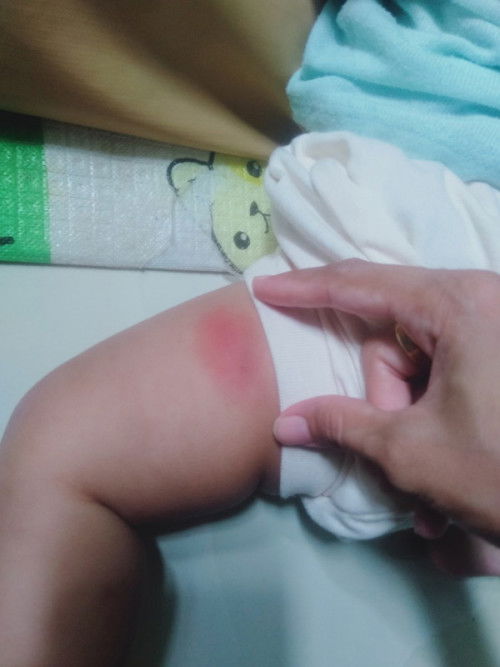 bekas suntik imunisasi dpt 3