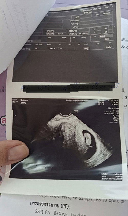 ตรวจขึ้น2ขีดไปอัลตราซาวด์ ตอน 8 w แต่ซาวด์ไม่เจอหัวใจหมอบอกต้องขูดมดลูก ตอนนี้ 10w 2d
ยังไม่มีอาการ