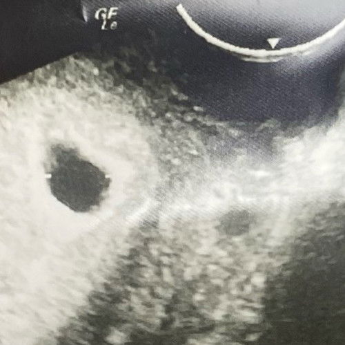 สอบถามหน่อยคะ แม่ๆเห็นถุงตั้งครรภ์กี่ถุงกันคะ เมื่อวันที่ 15 ได้มีการเลือดออกที่ช่องคลอด สีน้ำตาล/สีชมพู วันที่ 16 เลยไปหาหมอมาคะ