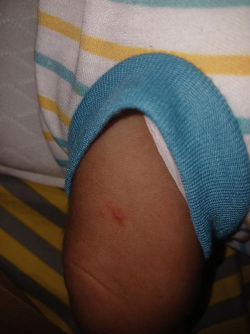 Benjolan kecil di paha