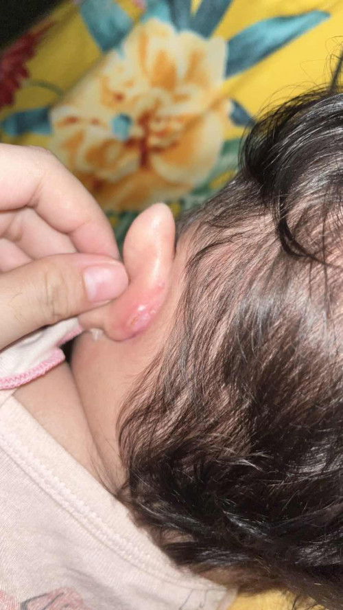 telinga belakang bayi sobek