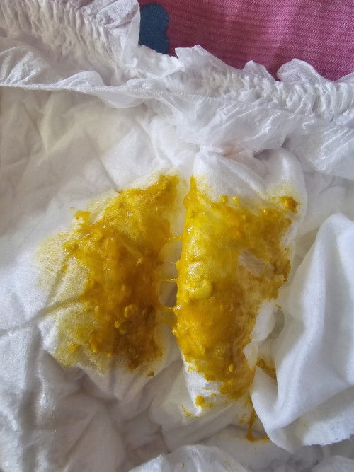 อุจจาระแบบนี้ท้องเสียมั๊ย