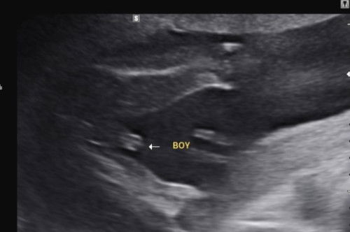 Detail scan masa 20week