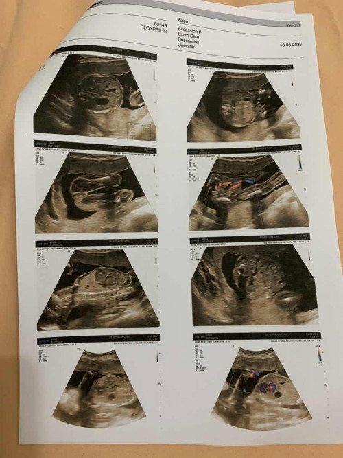 21+2 วีค อัลตร้าซาวด์