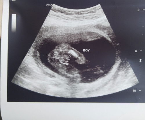 Gender at 19 weeks. Ilang % na sure na Kay huhu....