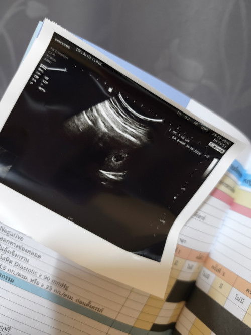 แม่ๆบ้านไหนอัลตร้าซาวด์ตอนกี่วีคกันค่ะ