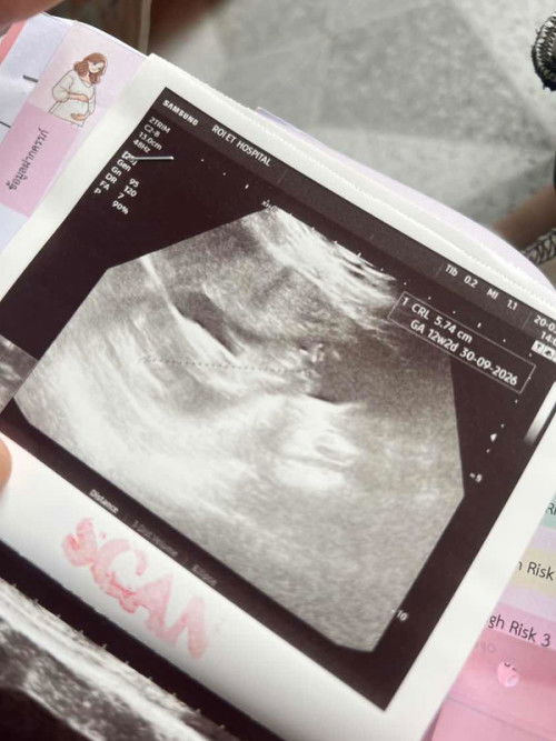 อายุครรภ์ 12w2d