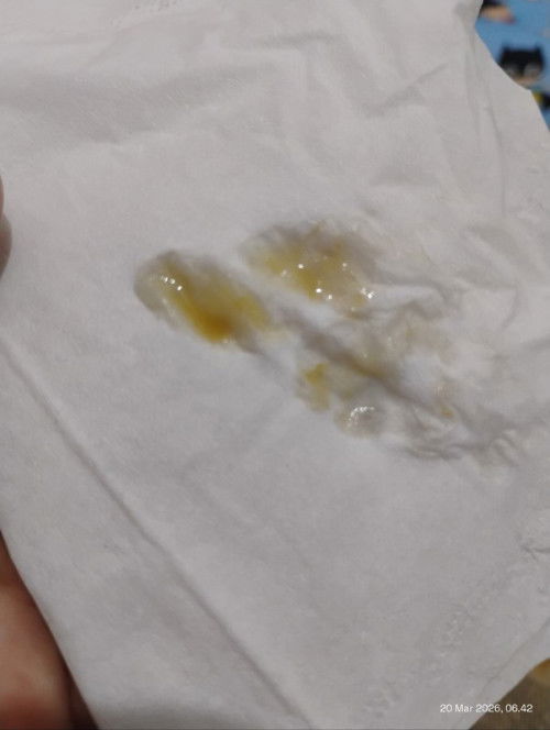 Bayi umur 4 bulan batuk pilek berdahak