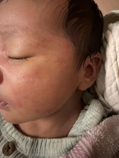 สิว ผื่นในเด็ก 20 วัน