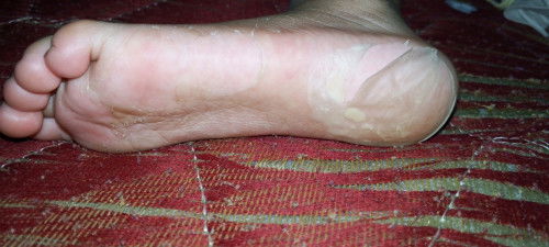 Rekomendasi sabun mandi, lotion dan sabun cuci bajunya .
Kaki anakku mengelupas