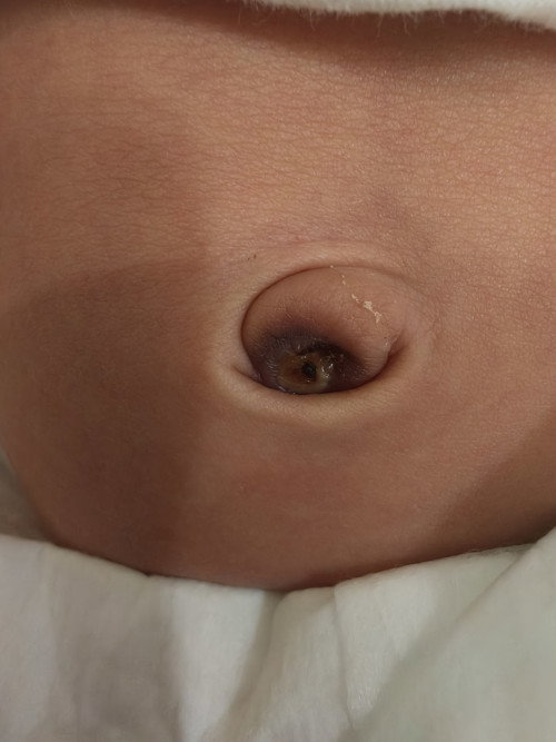 น้อง 18 วันสะดือหลุดวันนี้ แต่ข้างในยังมีขาวๆ ปกติมั้ยคะ