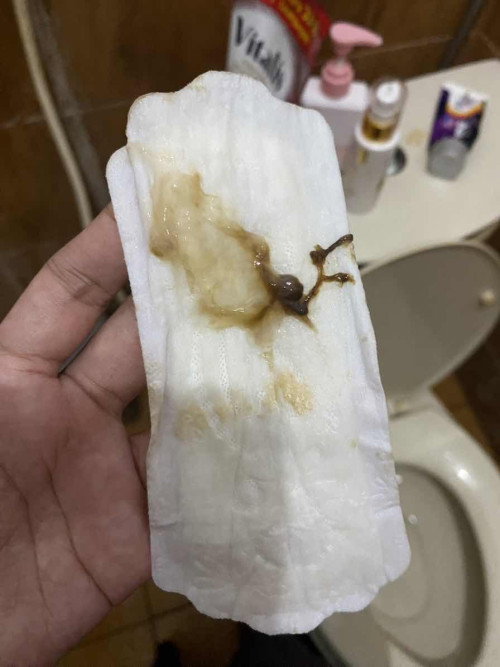 39 weeks - HPL 27 maret