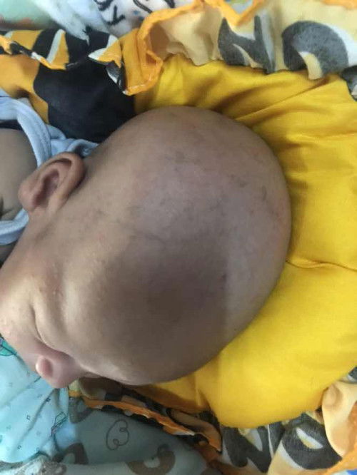 ผื่นในเด็กน้อย