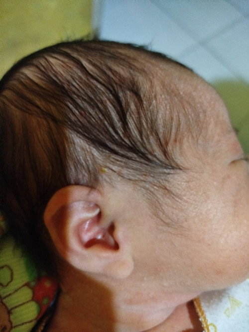 Mom,,gimana cara mengatasi bintik bernanah di kepala bayi usia 2minggu ya mom..,SPT di foto