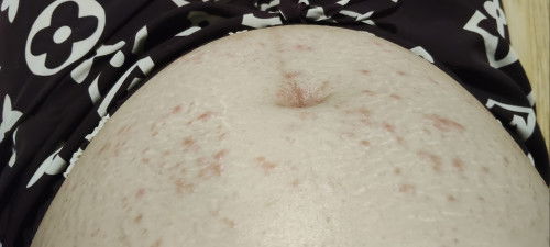 ตั้งครรภ์16wเป็นตุ่มคันแดงที่หน้าท้องและหน้าอก