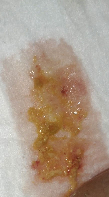 maaf ya bun mau tnya ini anakku fasesnya lendir campur darah ??? atau bukan 🙏🙏