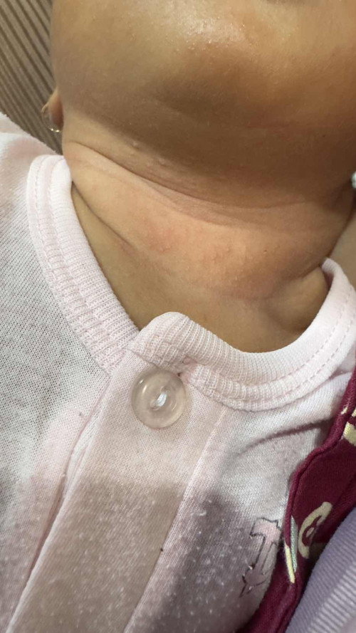 Bruntusab pada leher bayi