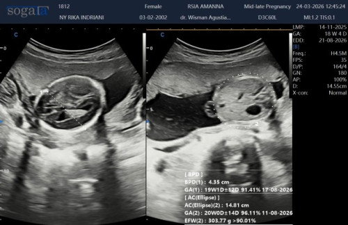 Hasil USG
#mohonbantujawabbunda🥲🥲🥲