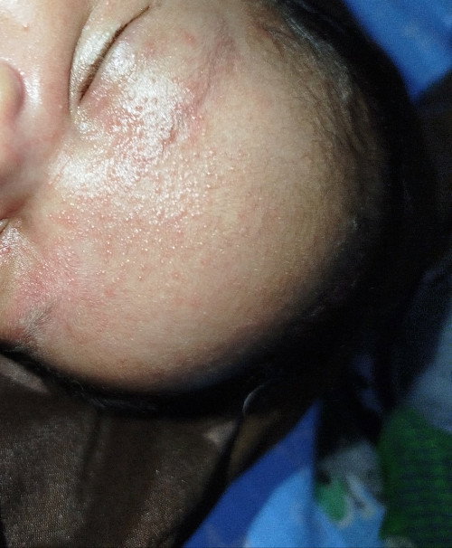 Buat ngilangin bruntusan pake apa ya?