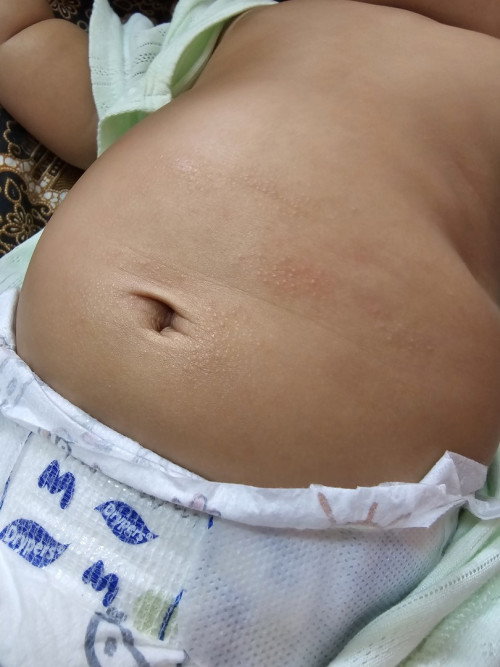 Bintik bintik di badan