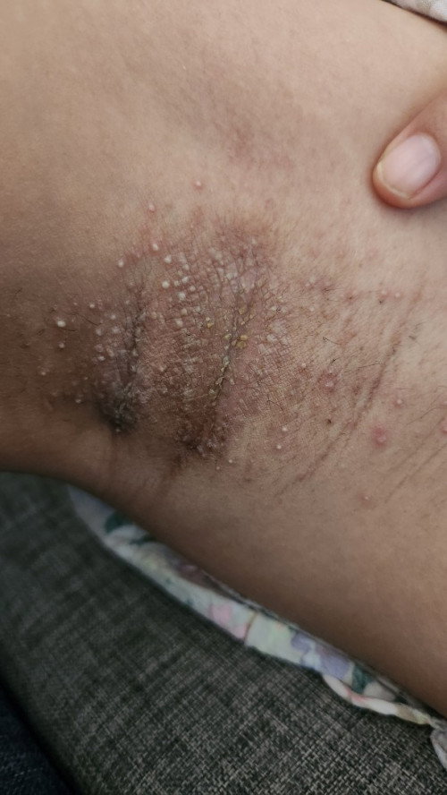 Ketiak lecet atau ruam