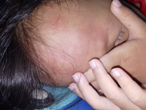 สวัสดีคะ สอบถามแม่คะ
ยุงกัด แพ้ยุง บ้านไหนลูกโดนยุงกัดแล้งเป็นแบบนี้บ้างคะ 3ขวบ