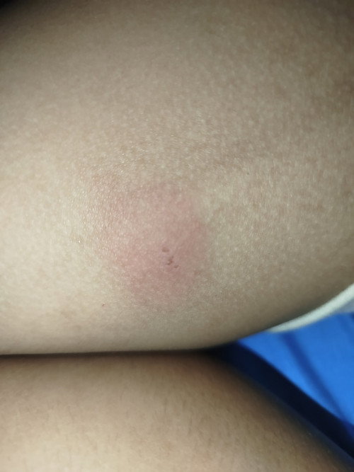 Ini cacar apa bukan ya