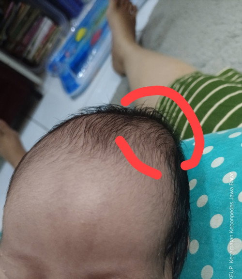 Bayi 1minggu, lahir dengan area kepala sebelah kanan empuk Dan seperti benjolan