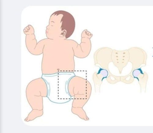 ข้อสะโพกหลุด