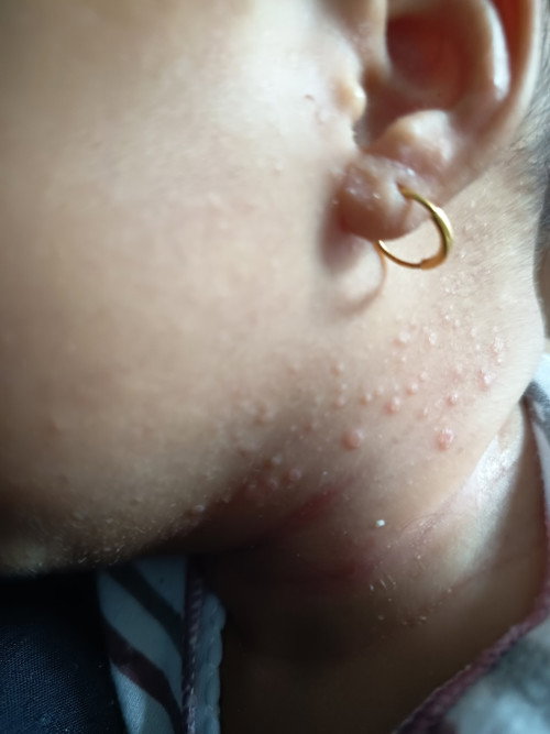 Bentol bentol di leher