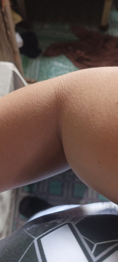 Butlig or chicken skin