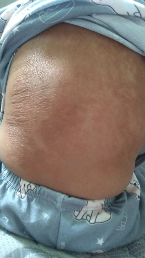 Ada yg tau kulit kering ini krna apa?