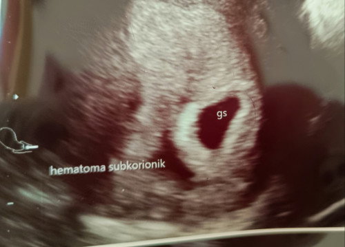 USG 6 minggu, hanya kantong dan ada hematoma dalam rahim.