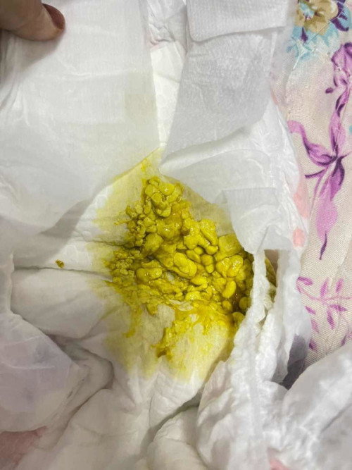 Berak ketul2 apa penyebab dia adakah normal?