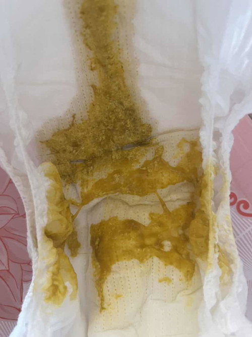 ลูกถ่ายเป็นมูก ถ่ายเป็นเหมือนดอกผักกาด มีกลิ่นเหม็นเปรี้ยว ถ่ายบ่อยแต่ถ่ายทีละนิด อาการแบบนี้คือปกติ หรือผิดปกติ ค่ะ