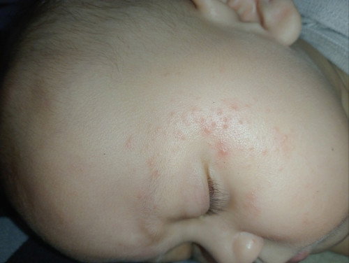 Wajah anak merah merah