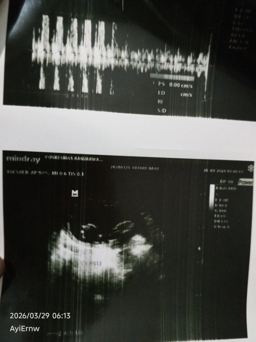 Hasil USG