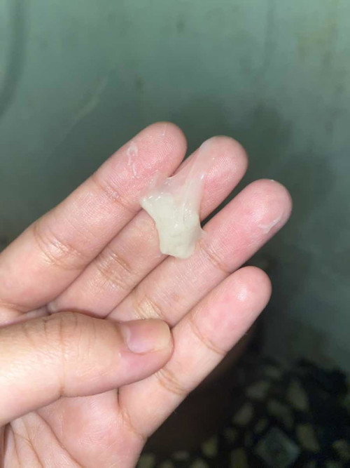 Discharge normal ba ito?