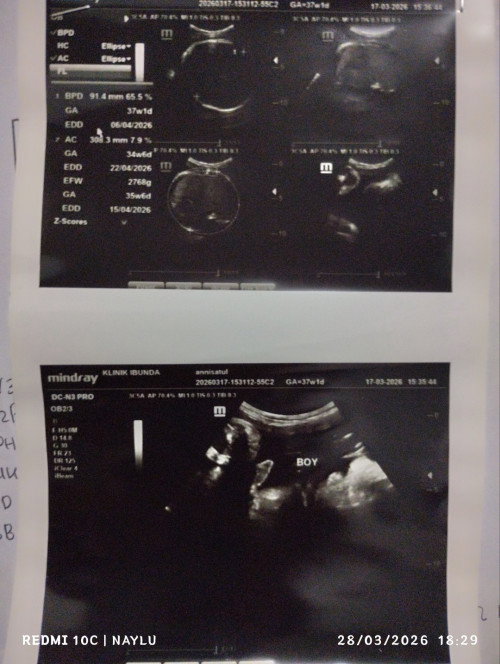 Hasil USG yg berubah, perempuan jadi laki-laki, ada yang sama bun? Atau sebaliknya?