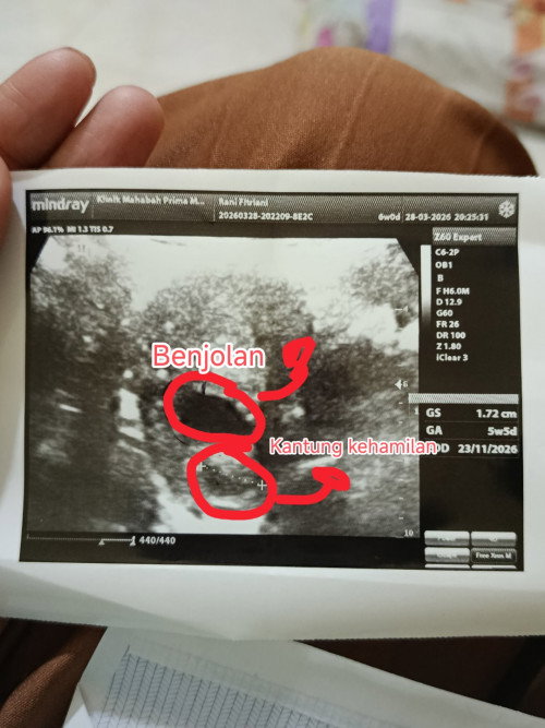 Hamil 5 minggu 6 Hari