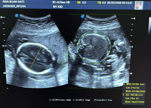 Air ketuban berkurang