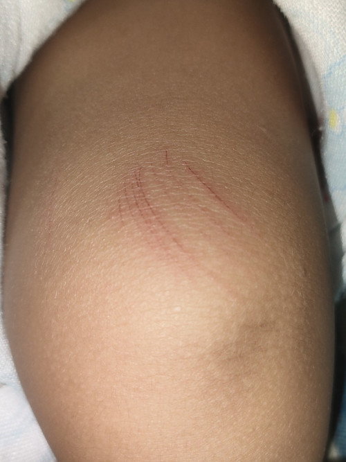 แผลแบบนี้โดนอะไรคะ