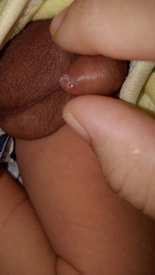 Warna kuning di penis si kecil
