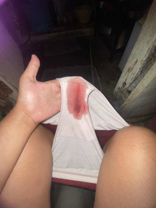 Regla po ba to or  implant