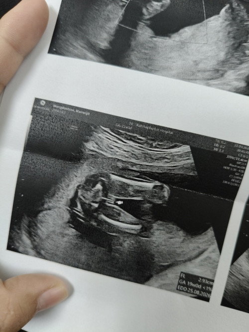 ภาพอัลตร้าซาวด์