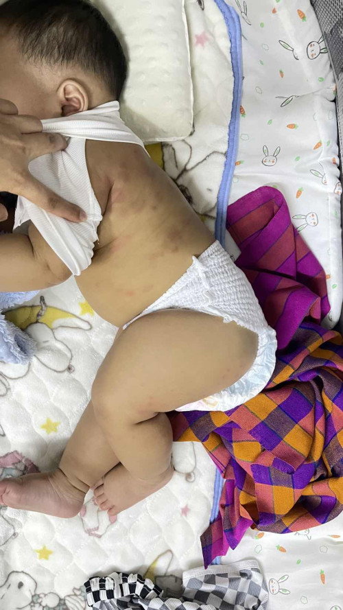 ลูกเป็นผื่นแบบนี้เรียกว่าอะไร