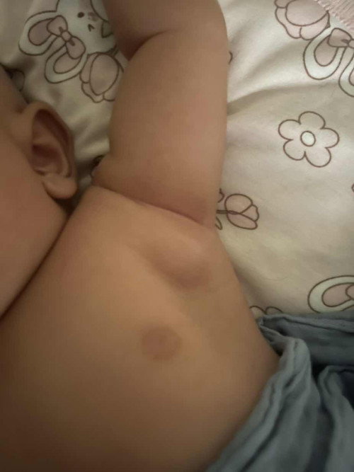 ketul dkt ketiak baby