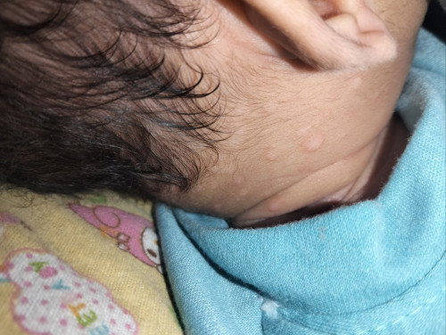 Bund . mau tanya 🙏🏻 ini sakit apa ya? Dan penyebab nya apa🙏🏻 baru ini liat bayi 1 bulan ada gini