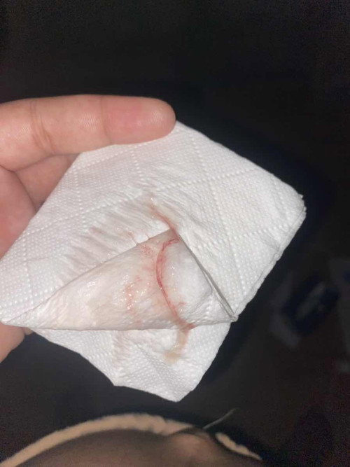 39+5 มีเลือดออก