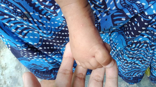 Masalah kulit bayi